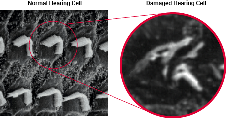 Diagram showing the difference between normal and damaged hearing cells