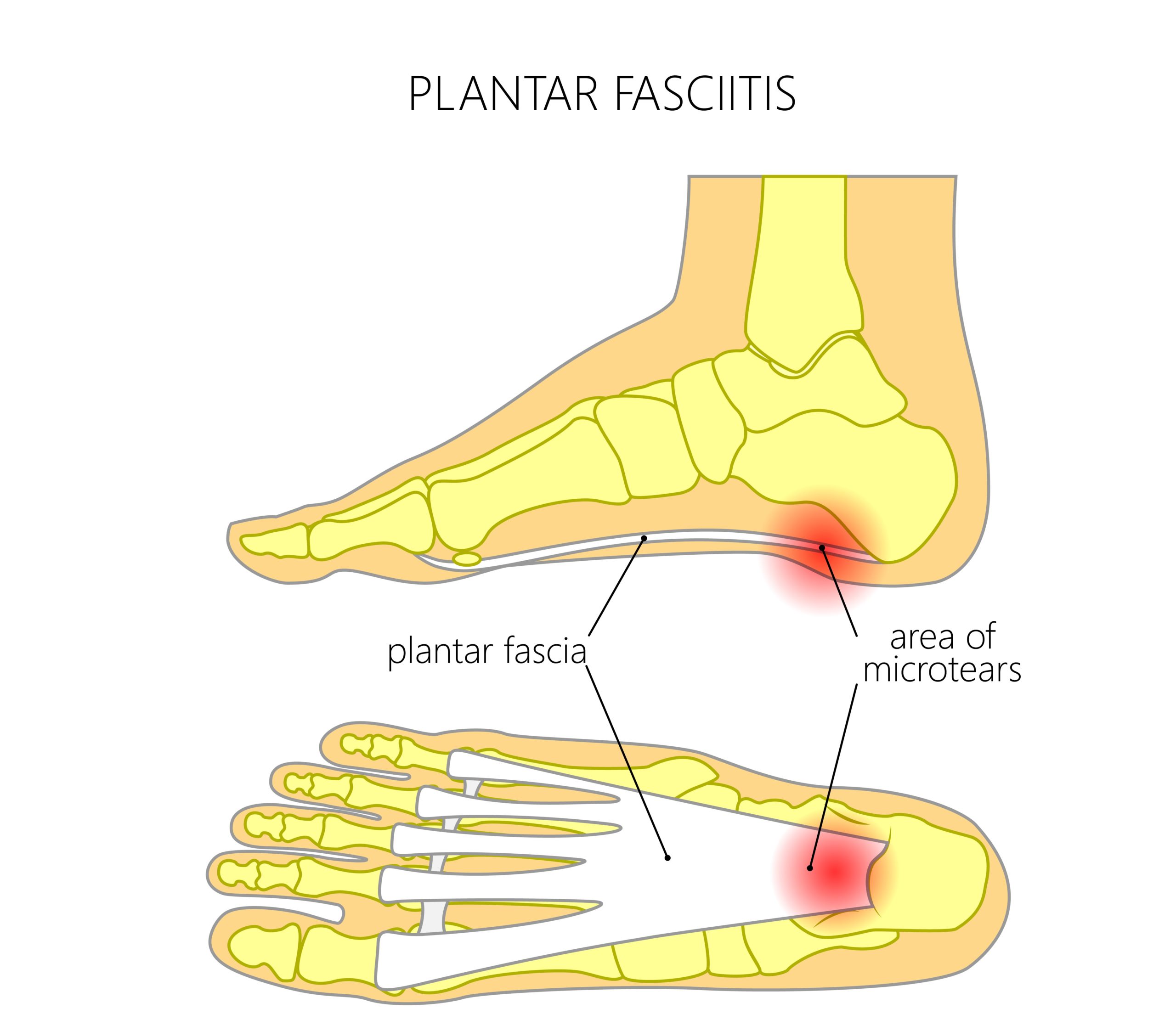 Plantar Fasciitis 