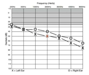 Sample audiogram