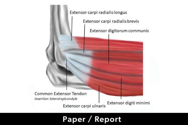 Feature image for the OHCOW report on Lateral Epicondylitis: Pathophysiology and Risk Factors